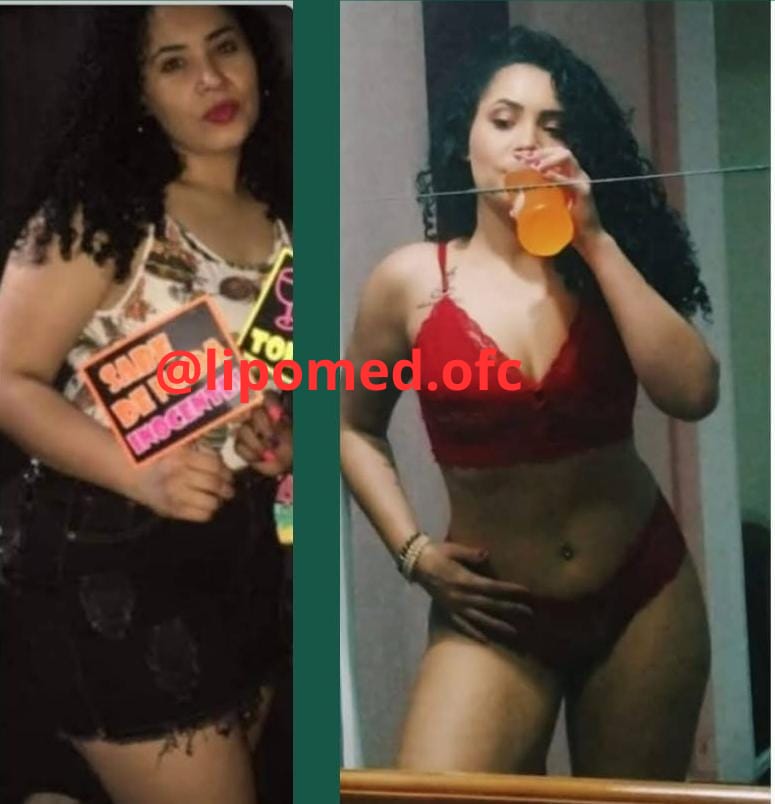 Antes e depois de cliente após uso do LipoMed